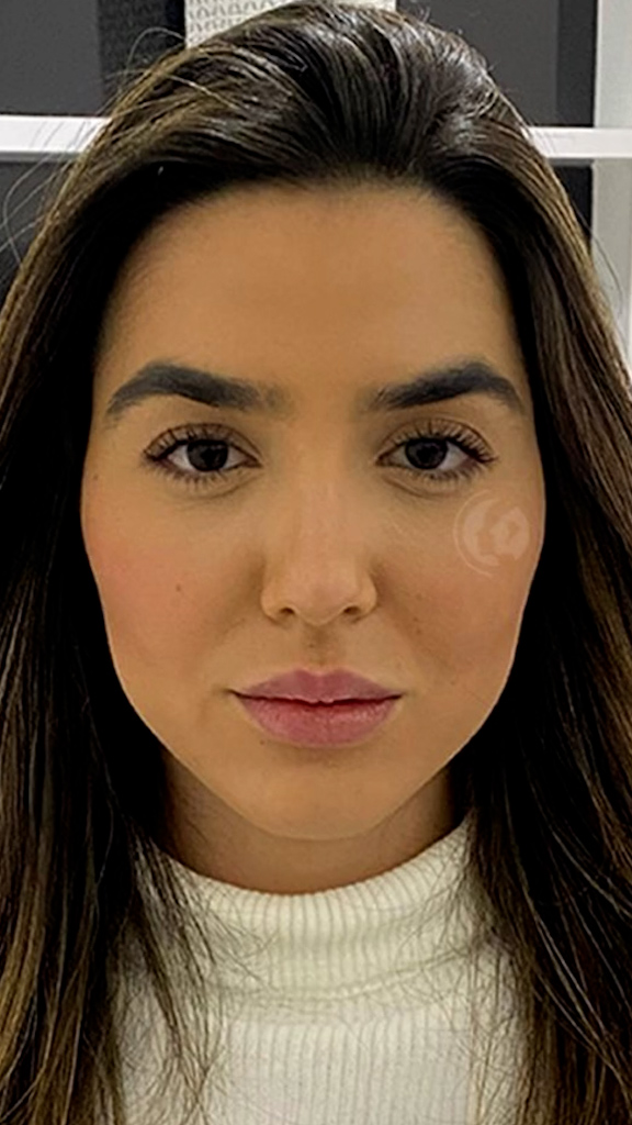 Caso 33 - Harmonização facial natural