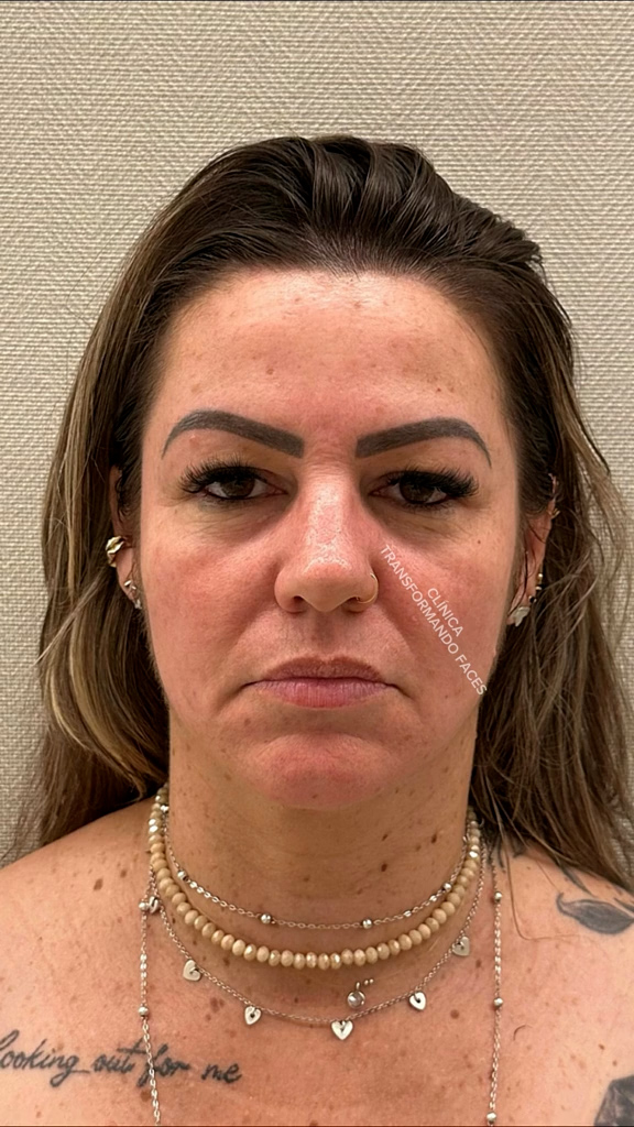Antes - Harmonização Facial - Est&eacute;tica Batel Curitiba