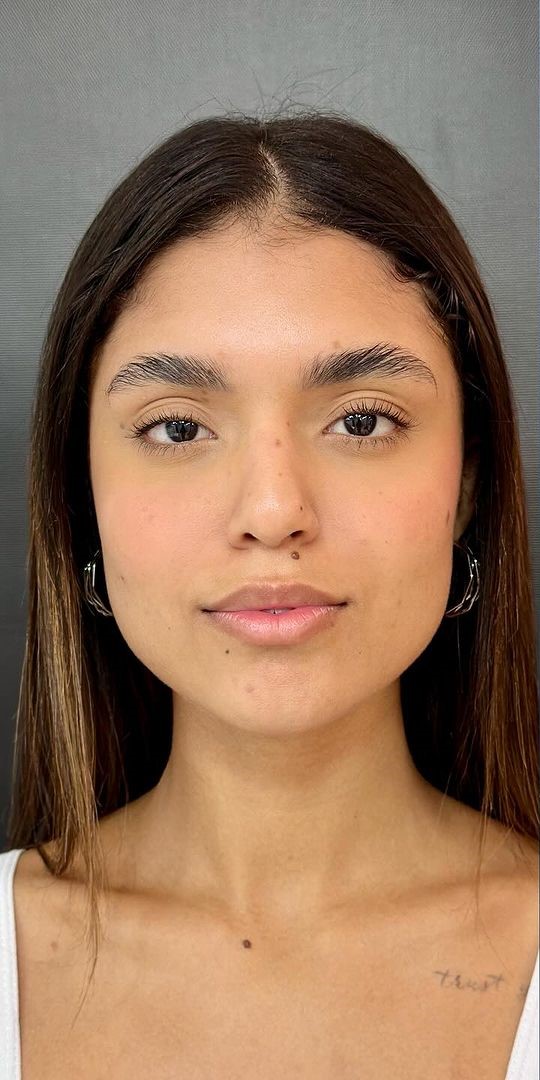 Antes - Harmonização Facial caso 38