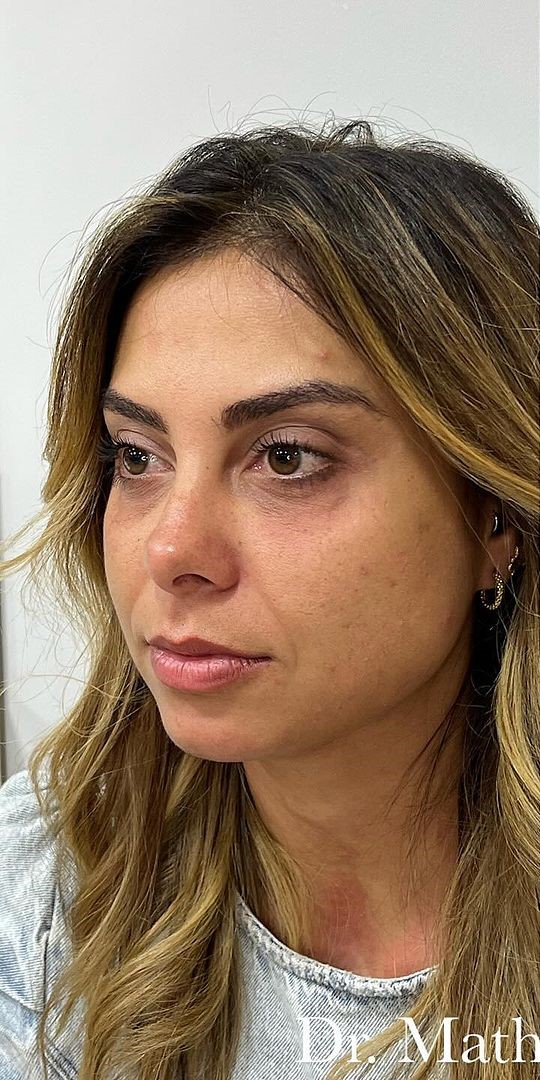 Antes - Harmonização Facial caso 41