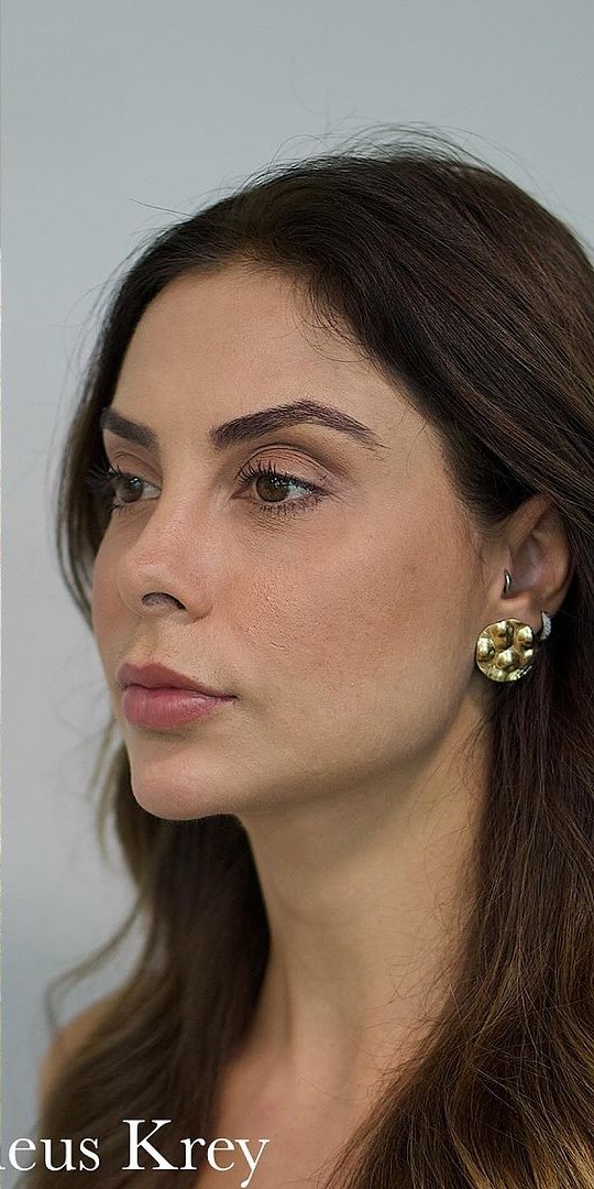 Depois - Harmonização Facial caso 41