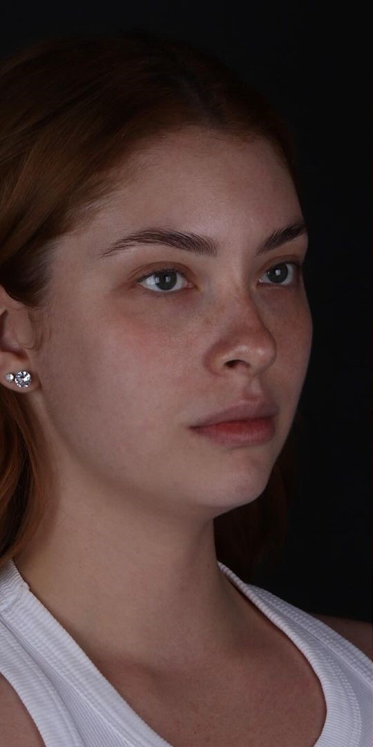 Antes - Harmonização Facial - Est&eacute;tica Batel Curitiba
