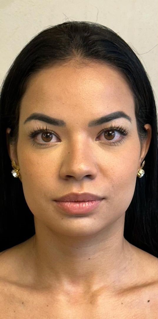 Antes - Harmonização Facial - Est&eacute;tica Batel Curitiba