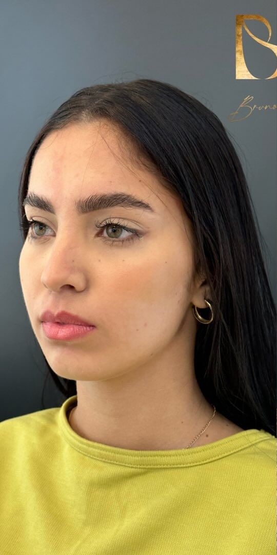 Antes - Harmonização Facial caso 45
