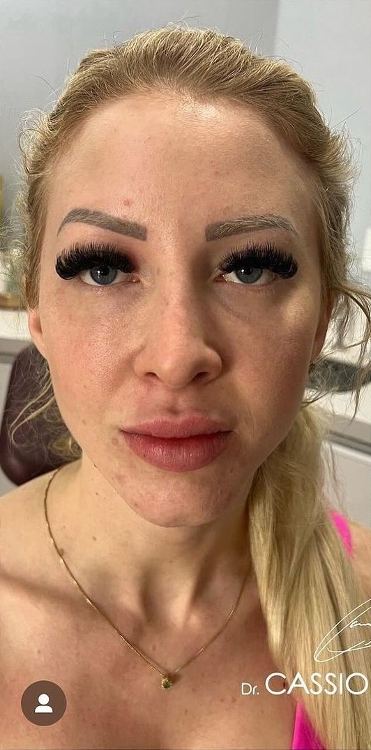 Antes - Harmonização Facial caso 46