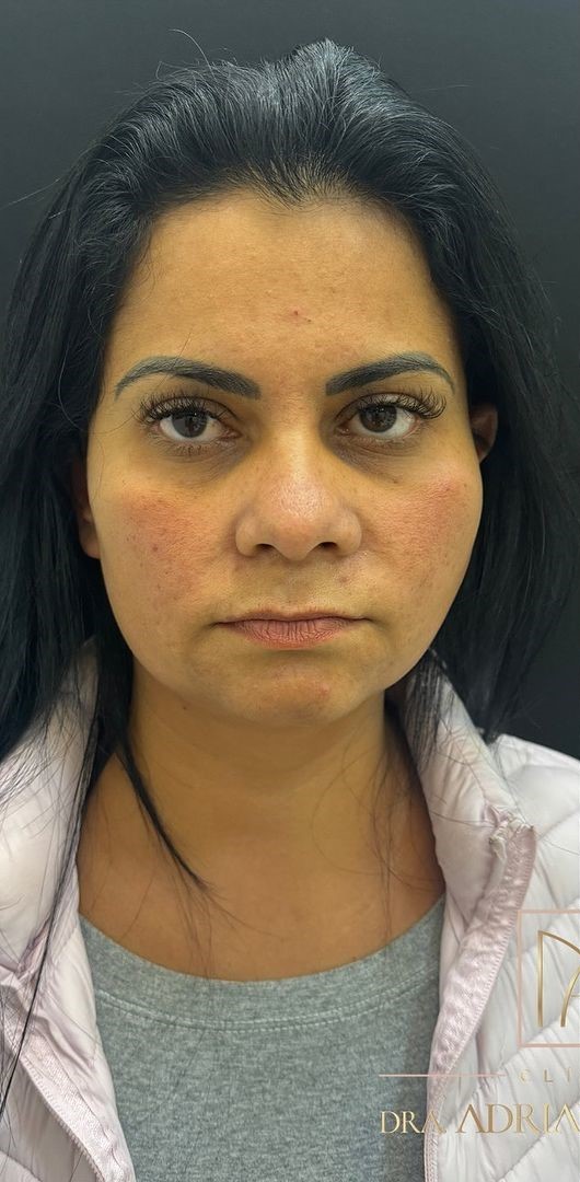 Antes - Harmonização Facial - Est&eacute;tica Batel Curitiba