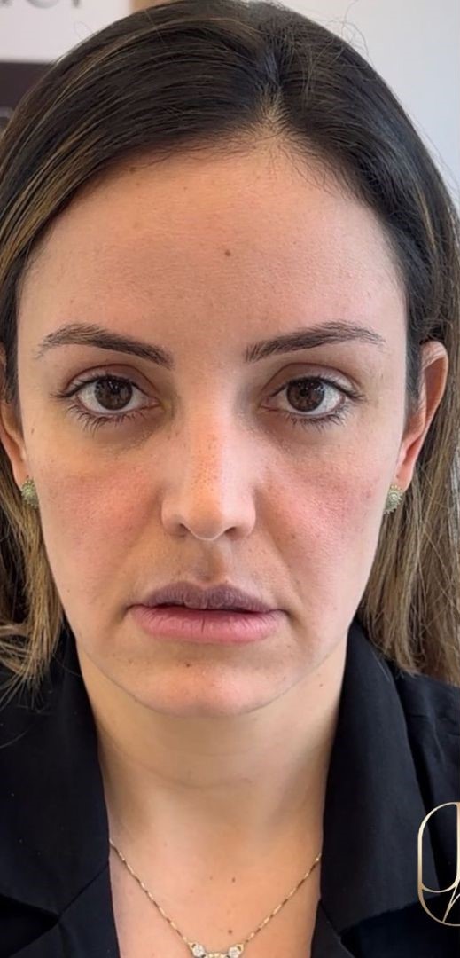 Antes - Harmonização Facial - Est&eacute;tica Batel Curitiba
