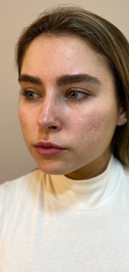 Antes - Harmonização Facial caso 50