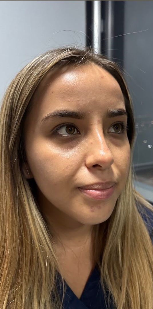 Antes - Harmonização Facial caso 51