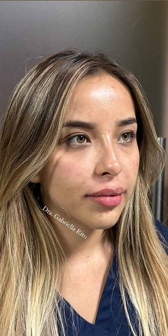 Depois - Harmonização Facial caso 51