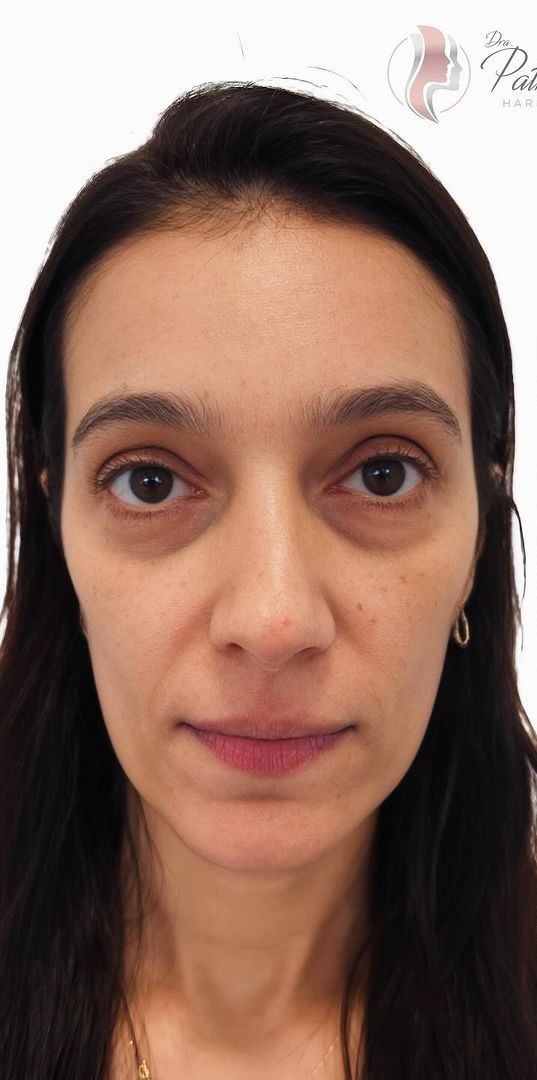 Antes - Harmonização Facial - Est&eacute;tica Batel Curitiba