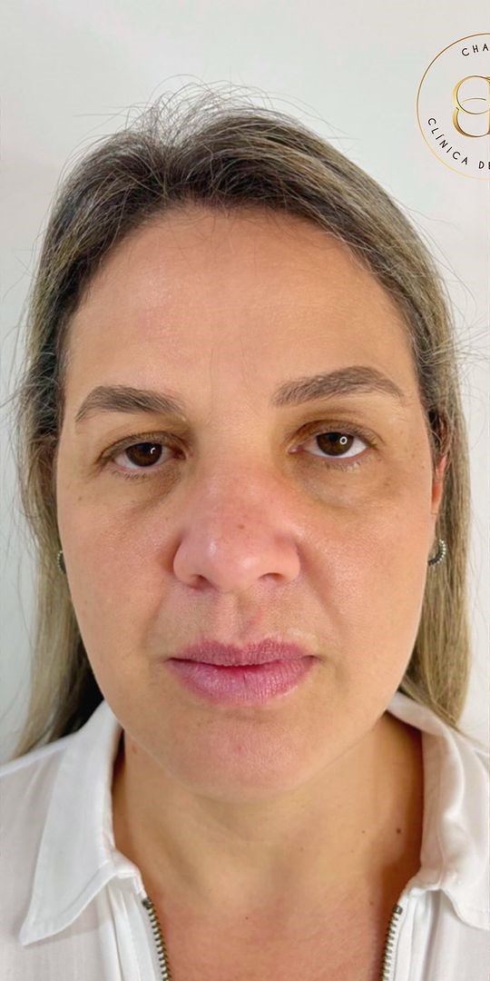 Antes - Harmonização Facial - Est&eacute;tica Batel Curitiba