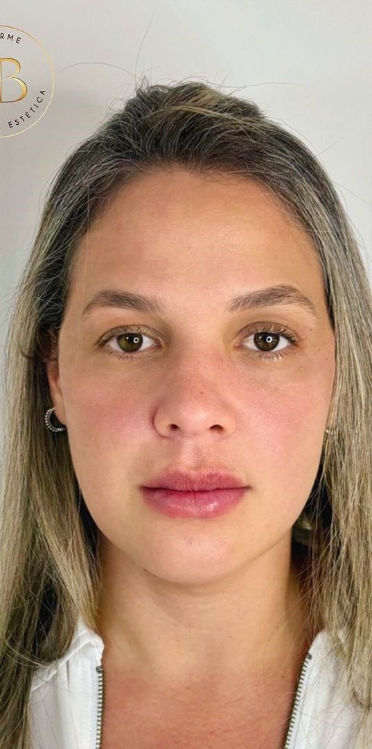 Caso 53 - Harmonização e frescor do rosto