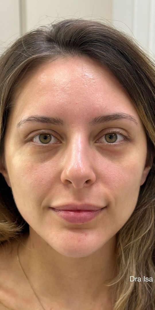 Antes - Harmonização Facial caso 54
