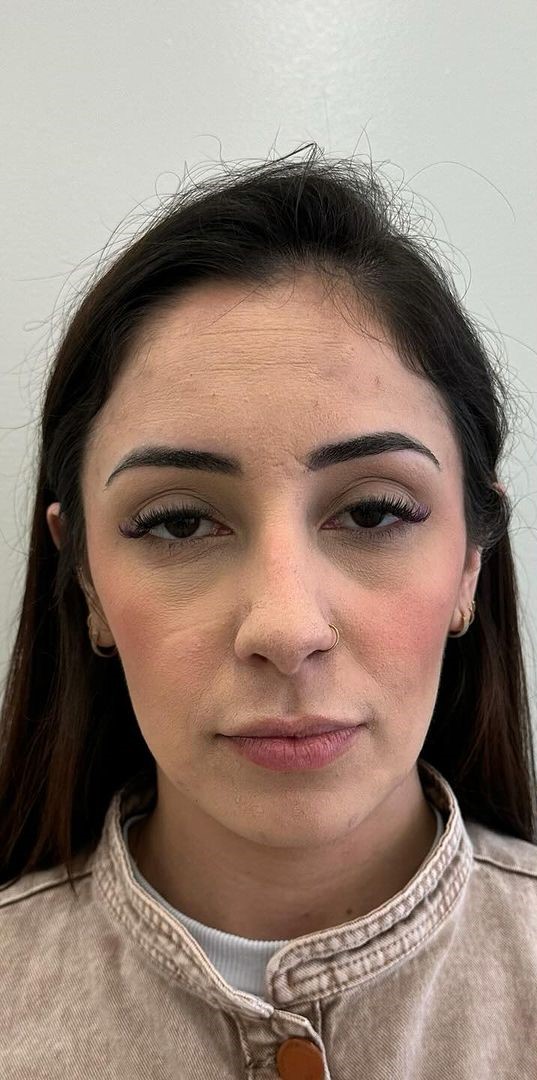 Antes - Harmonização Facial caso 57