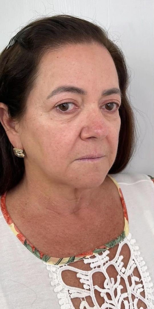 Antes - Harmonização Facial caso 58