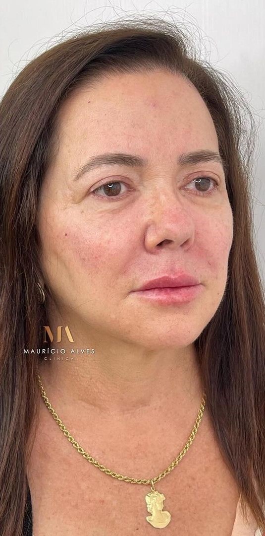 Depois - Harmonização Facial caso 58