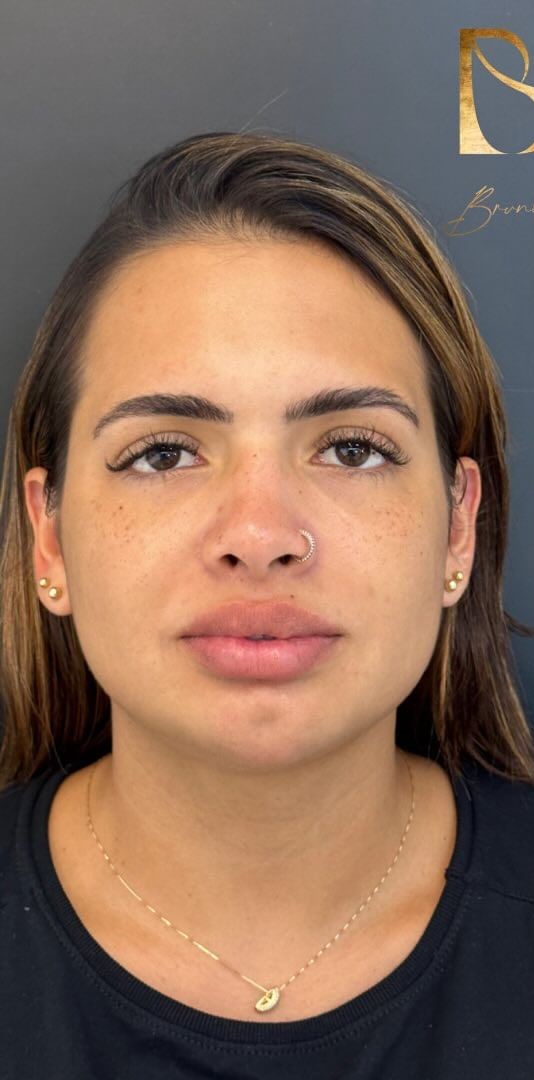 Antes - Harmonização Facial caso 60