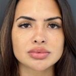 Resultado de harmonização facial
