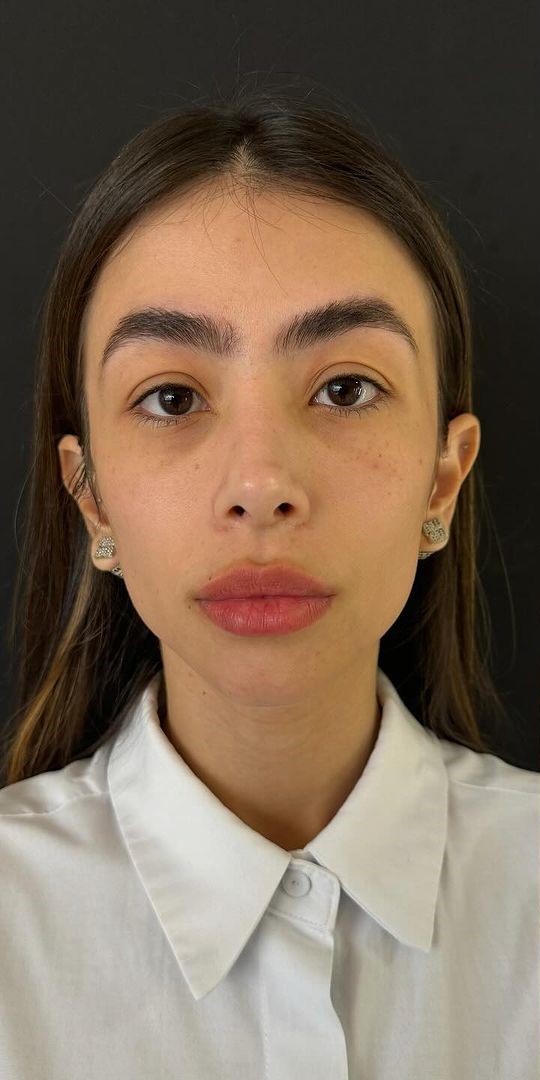 Antes - Harmonização Facial caso 62
