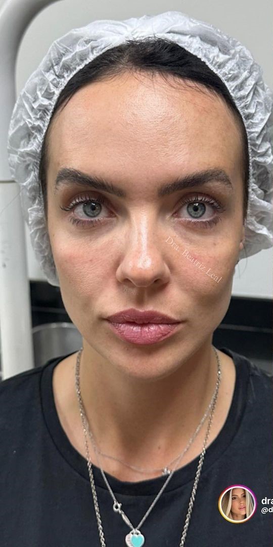 Antes - Harmonização Facial caso 63
