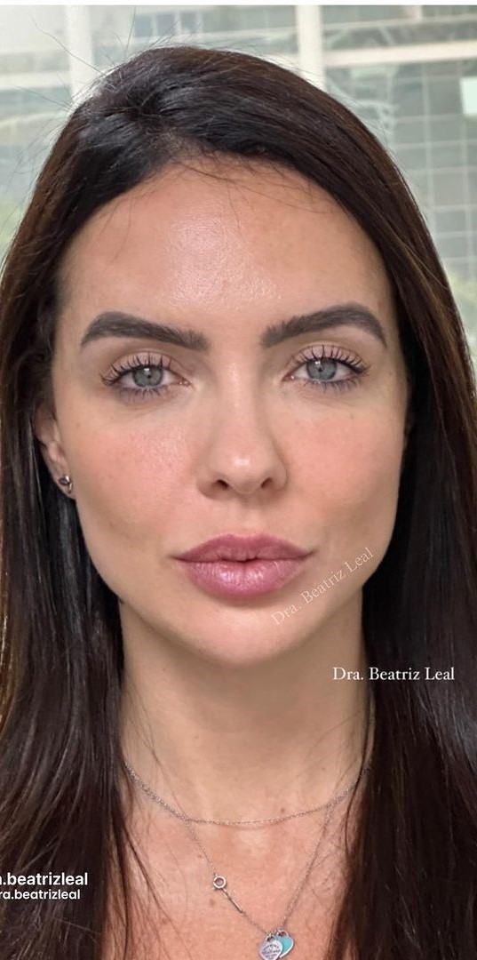 Depois - Harmonização Facial caso 63
