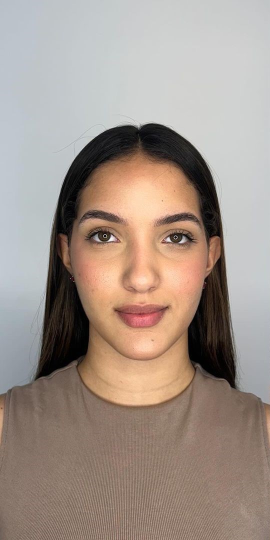 Antes - Harmonização Facial caso 64