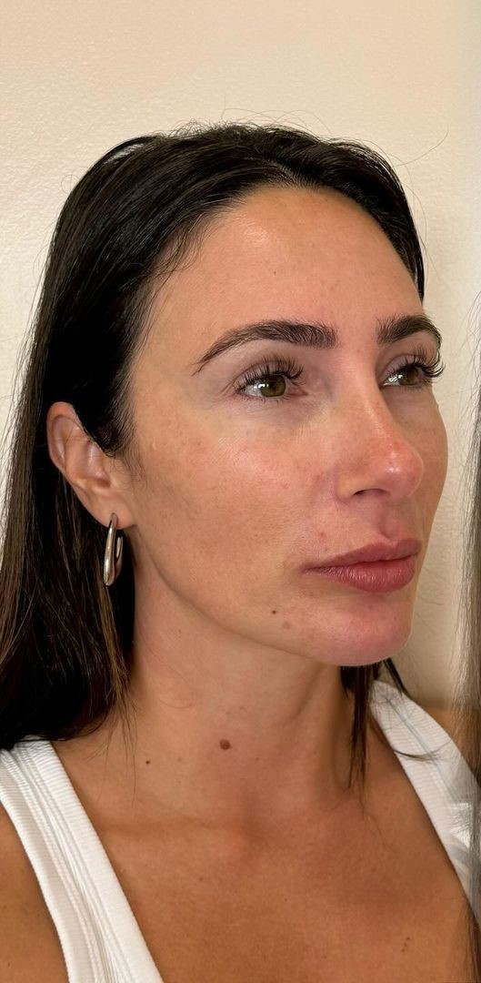Antes - Harmonização Facial caso 65
