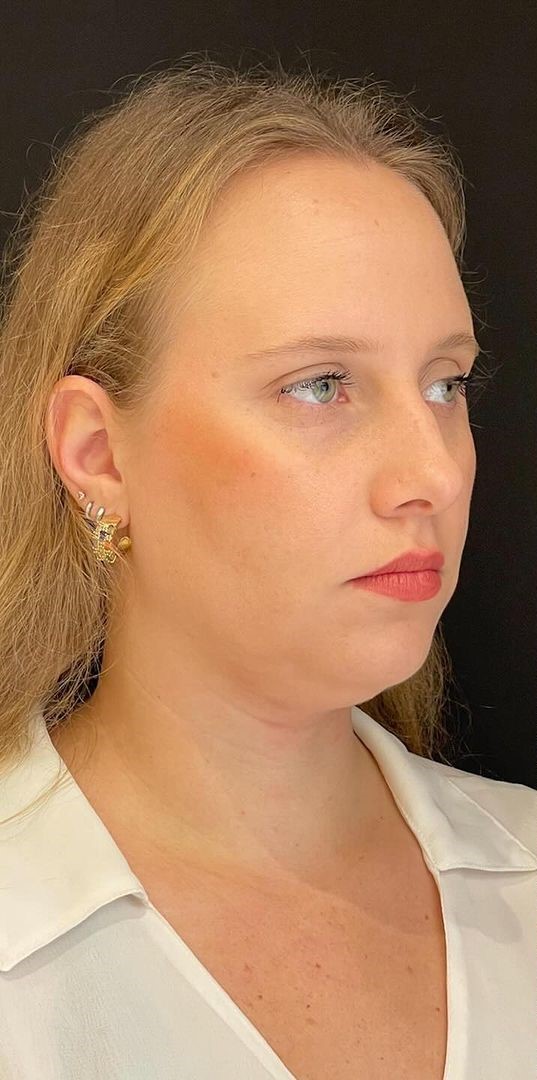 Antes - Harmonização Facial caso 67