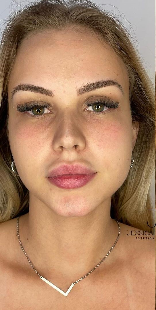 Antes - Harmonização Facial - Est&eacute;tica Batel Curitiba