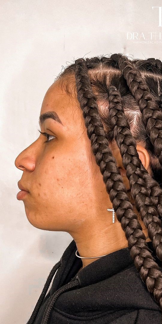 Antes - Harmonização Facial caso 71