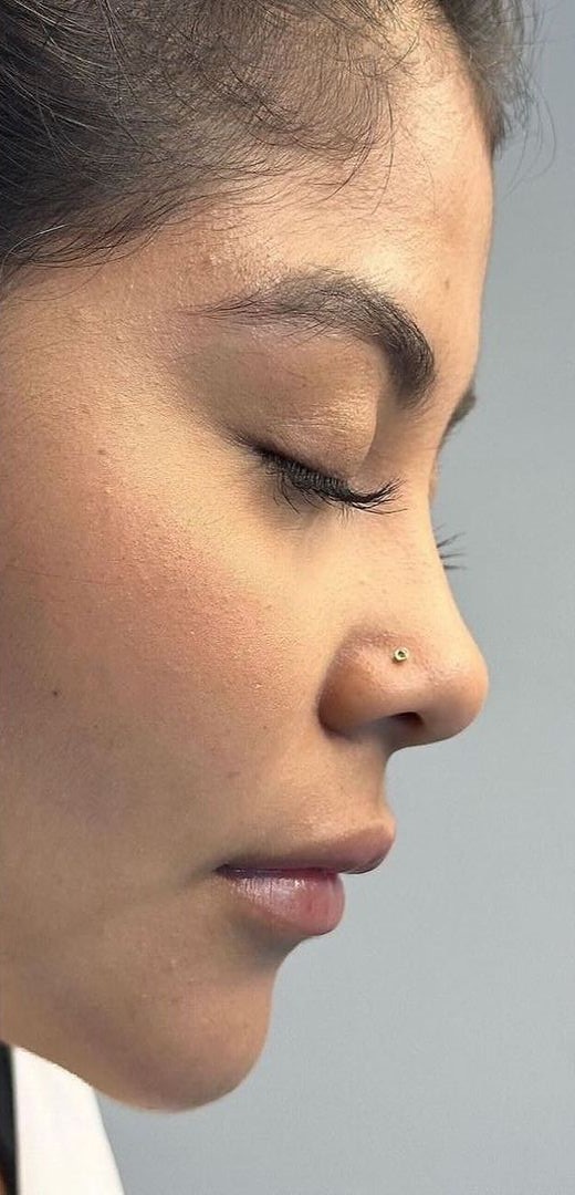 Antes - Harmonização Facial caso 72