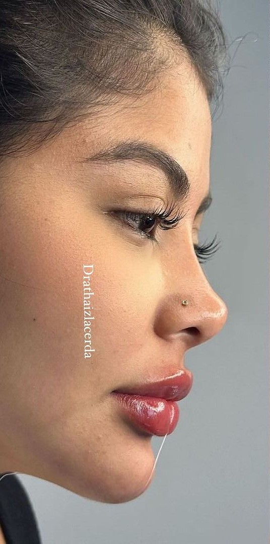 Depois - Harmonização Facial caso 72