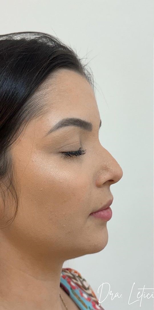 Antes - Harmonização Facial - Est&eacute;tica Batel Curitiba