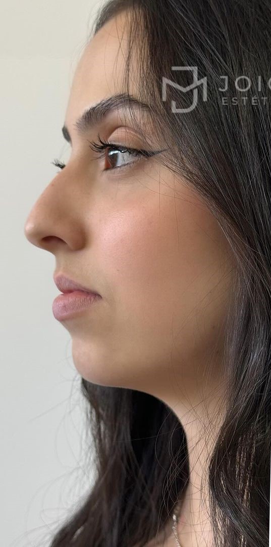 Antes - Harmonização Facial - Est&eacute;tica Batel Curitiba