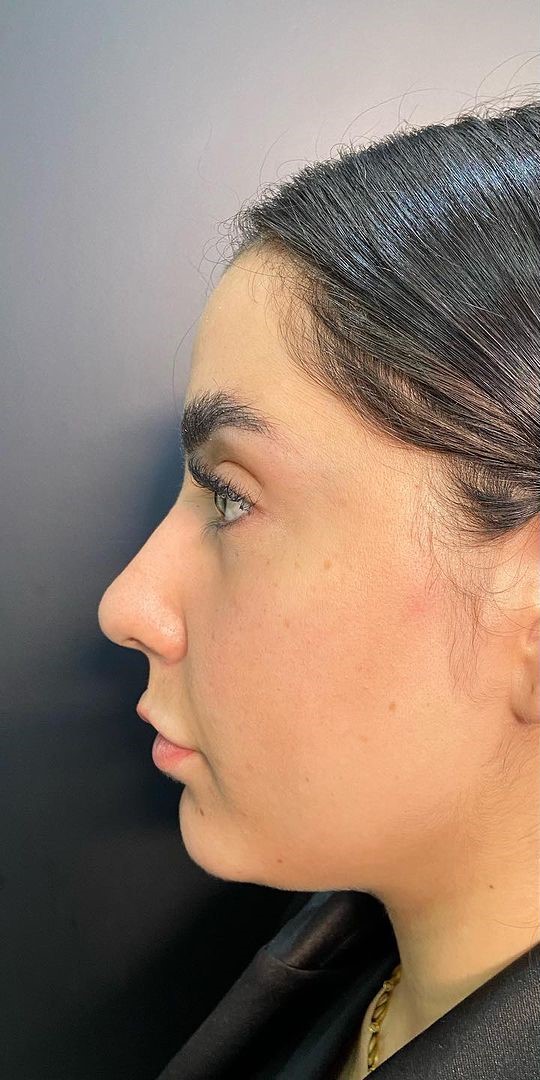 Antes - Harmonização Facial caso 76