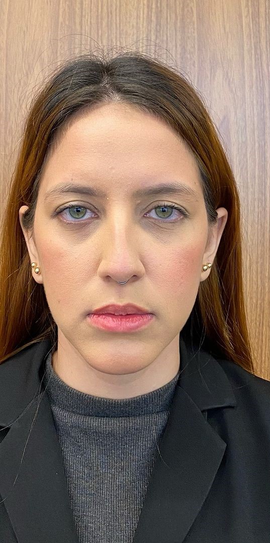 Antes - Harmonização Facial - Est&eacute;tica Batel Curitiba