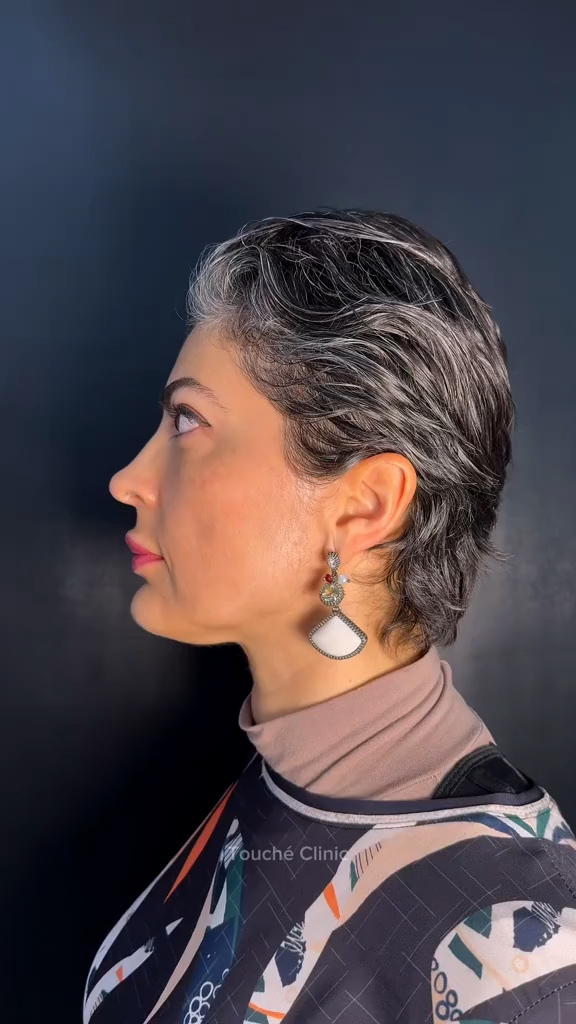 Antes - Harmonização Facial - Est&eacute;tica Batel Curitiba