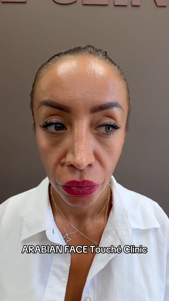 Antes - Harmonização Facial caso 83