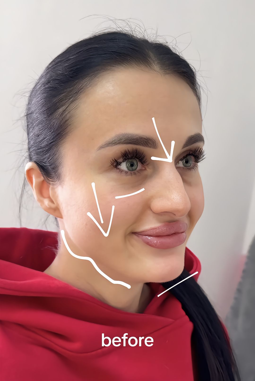 Antes - Harmonização Facial caso 86