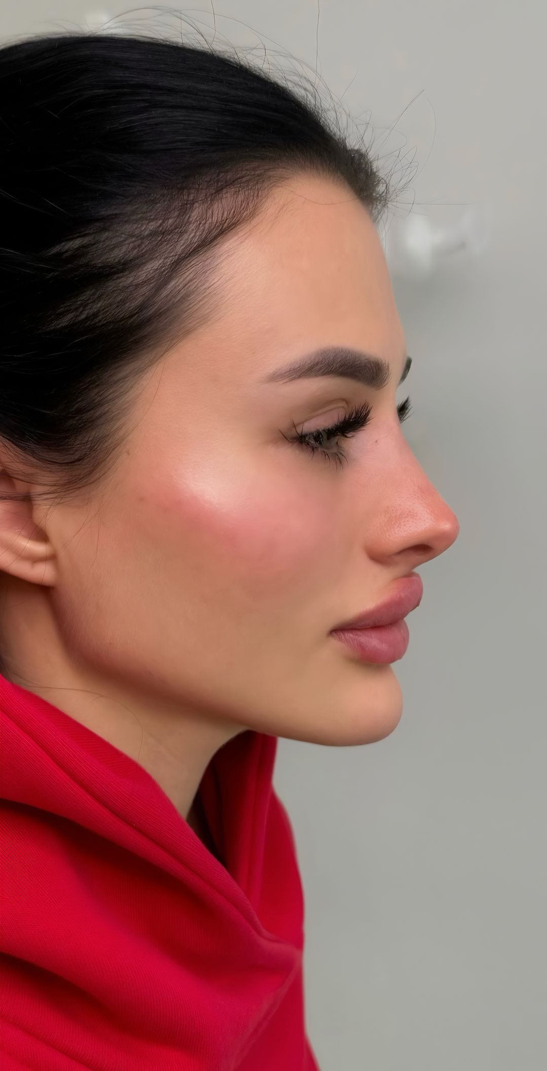 Depois - Harmonização Facial caso 86