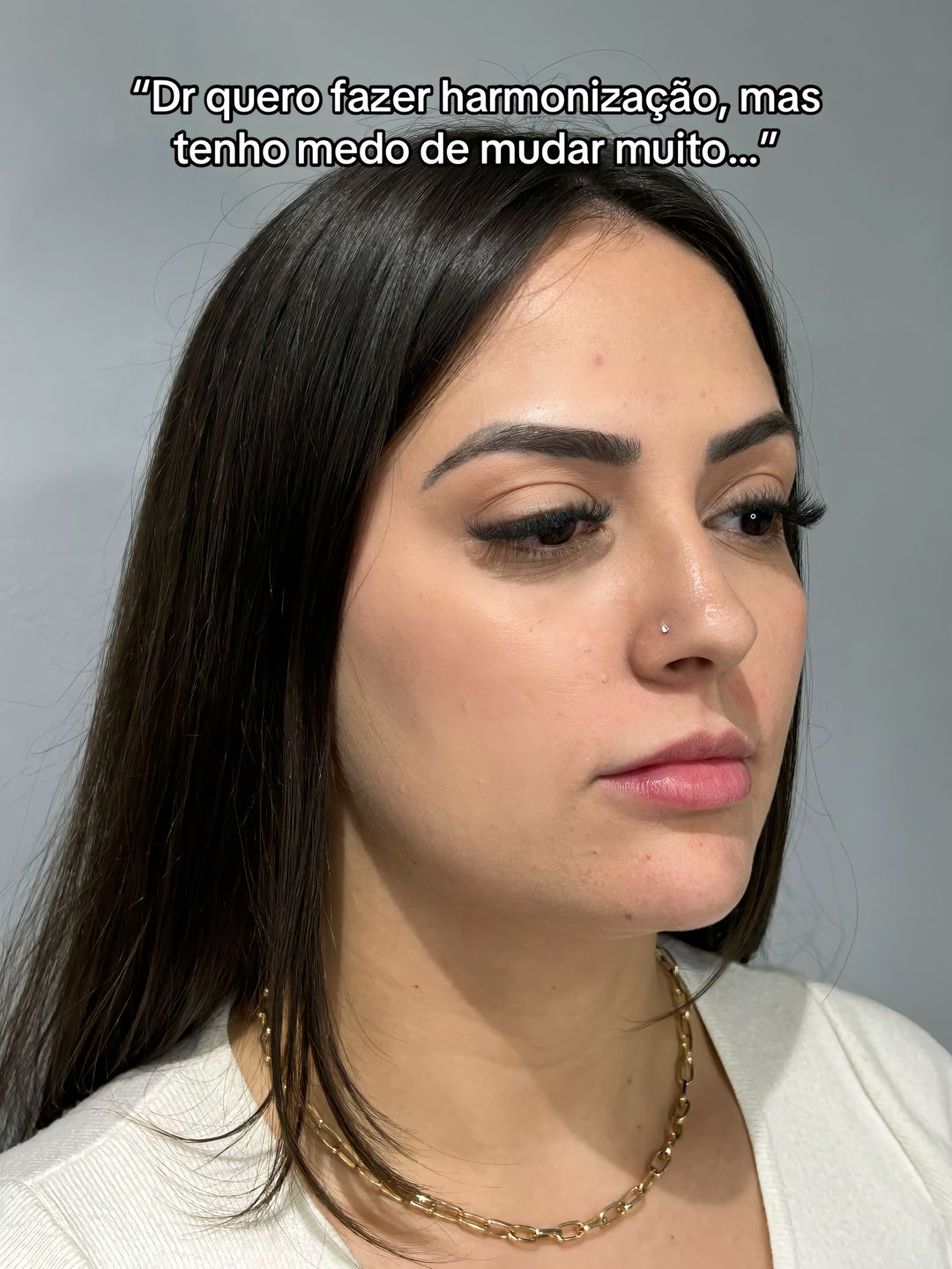 Antes - Harmonização Facial caso 88