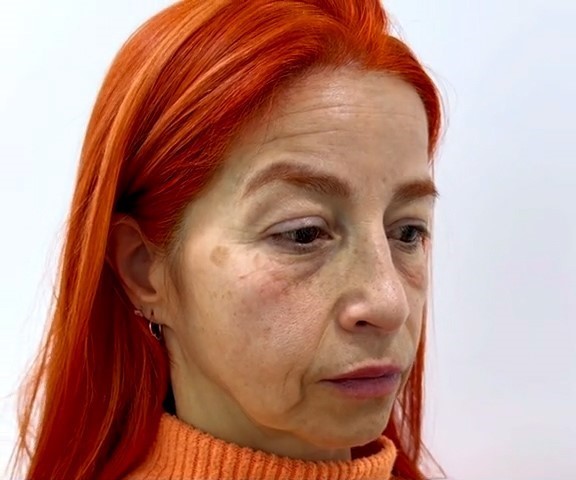 Antes - Marionete - Est&eacute;tica Batel Curitiba