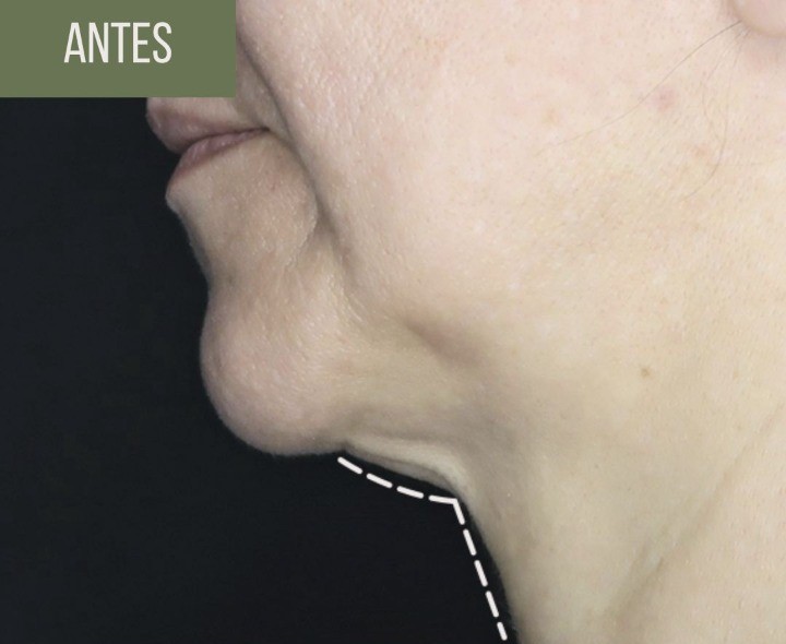 Papada antes do tratamento — caso real documentado, Estética Batel