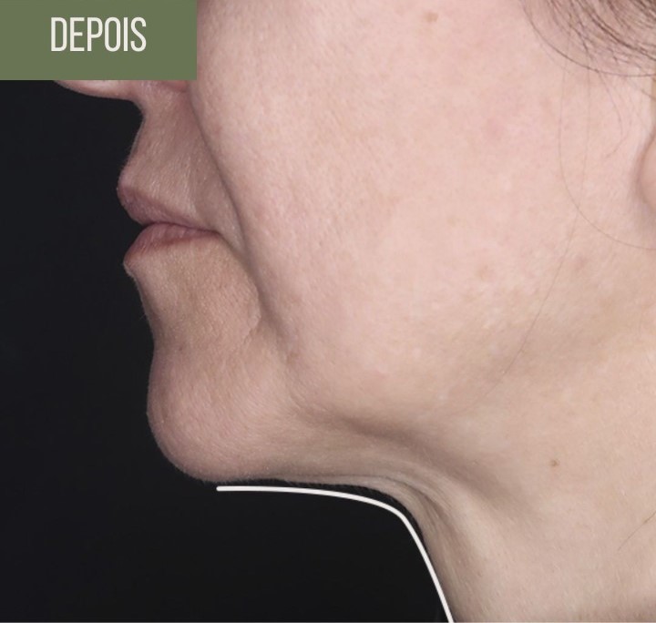 Papada caso 001 — antes e depois