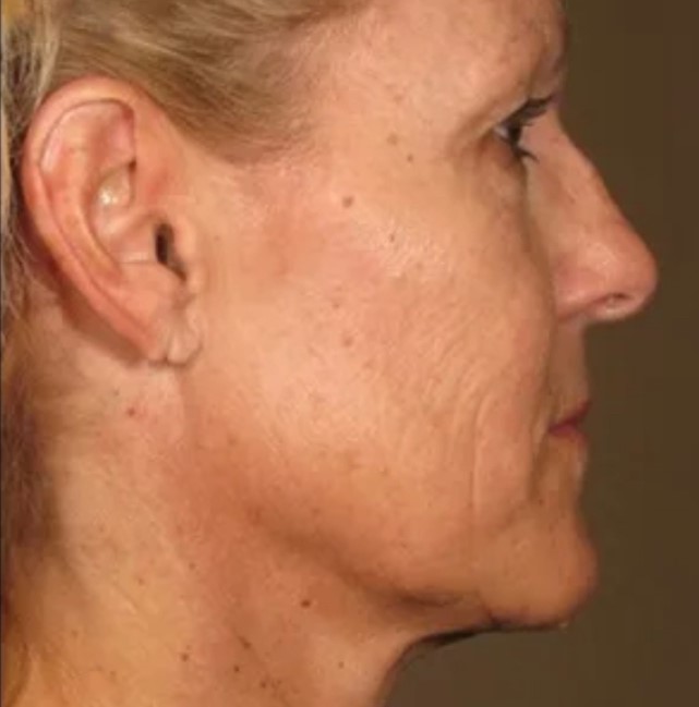 Papada caso 003 — antes e depois