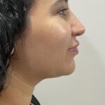 Resultado de tratamento de papada