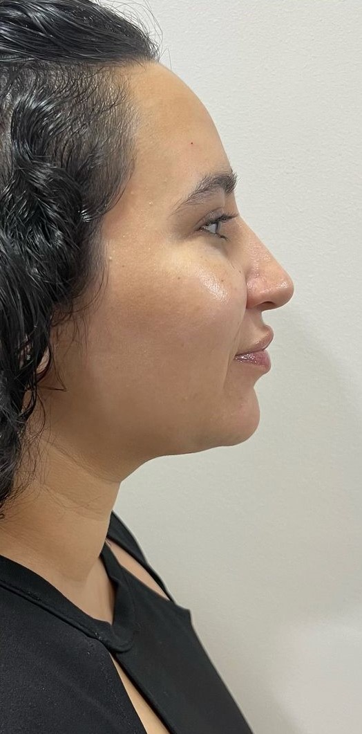 Papada caso 004 — antes e depois