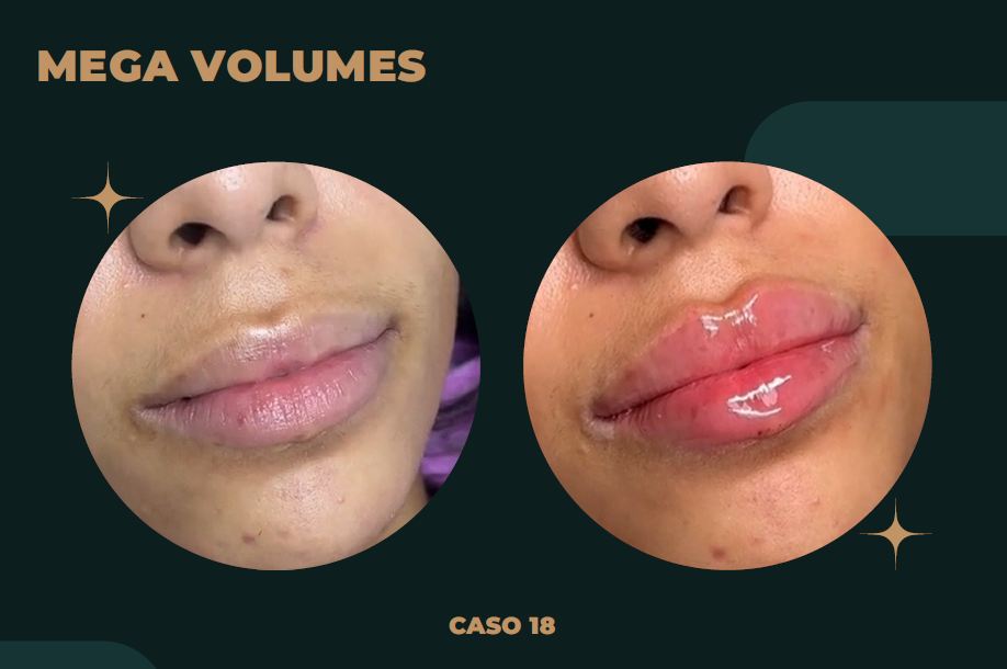Preenchimento Labial · Diamantação — Caso 03, antes e depois de mega volume