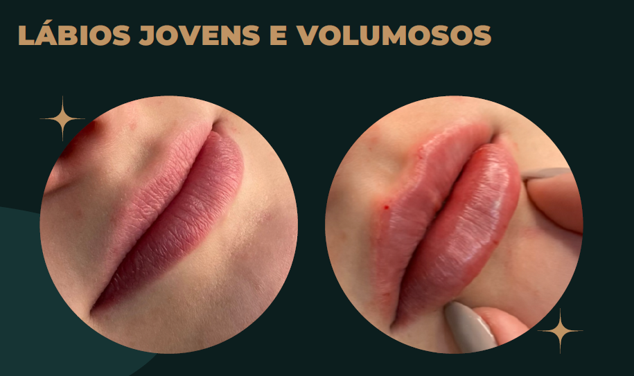 Preenchimento Labial · antes e depois